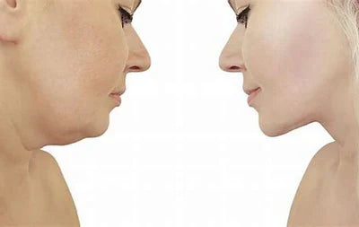 Fat Dissolvers: A Non-Surgical Solution for Stubborn Fat